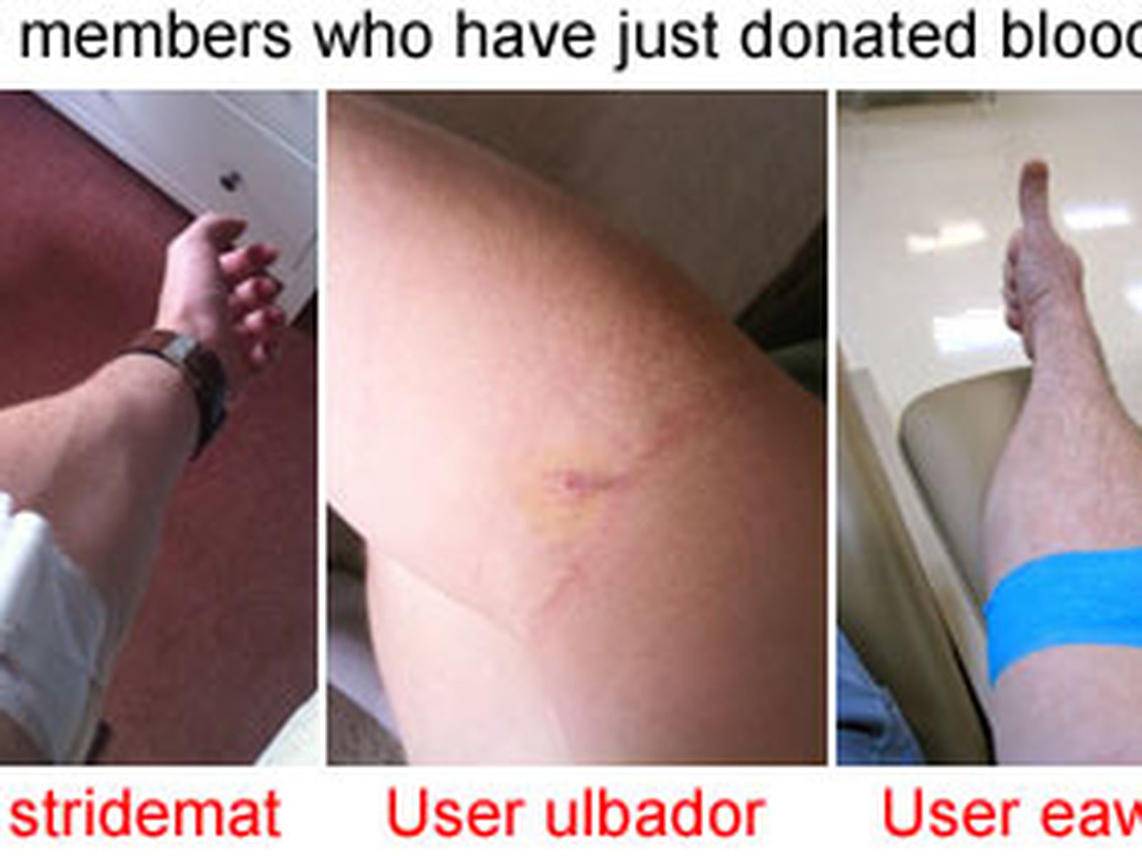 plasma donation scars