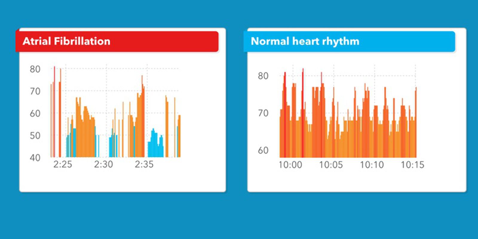 heart rhythm chart